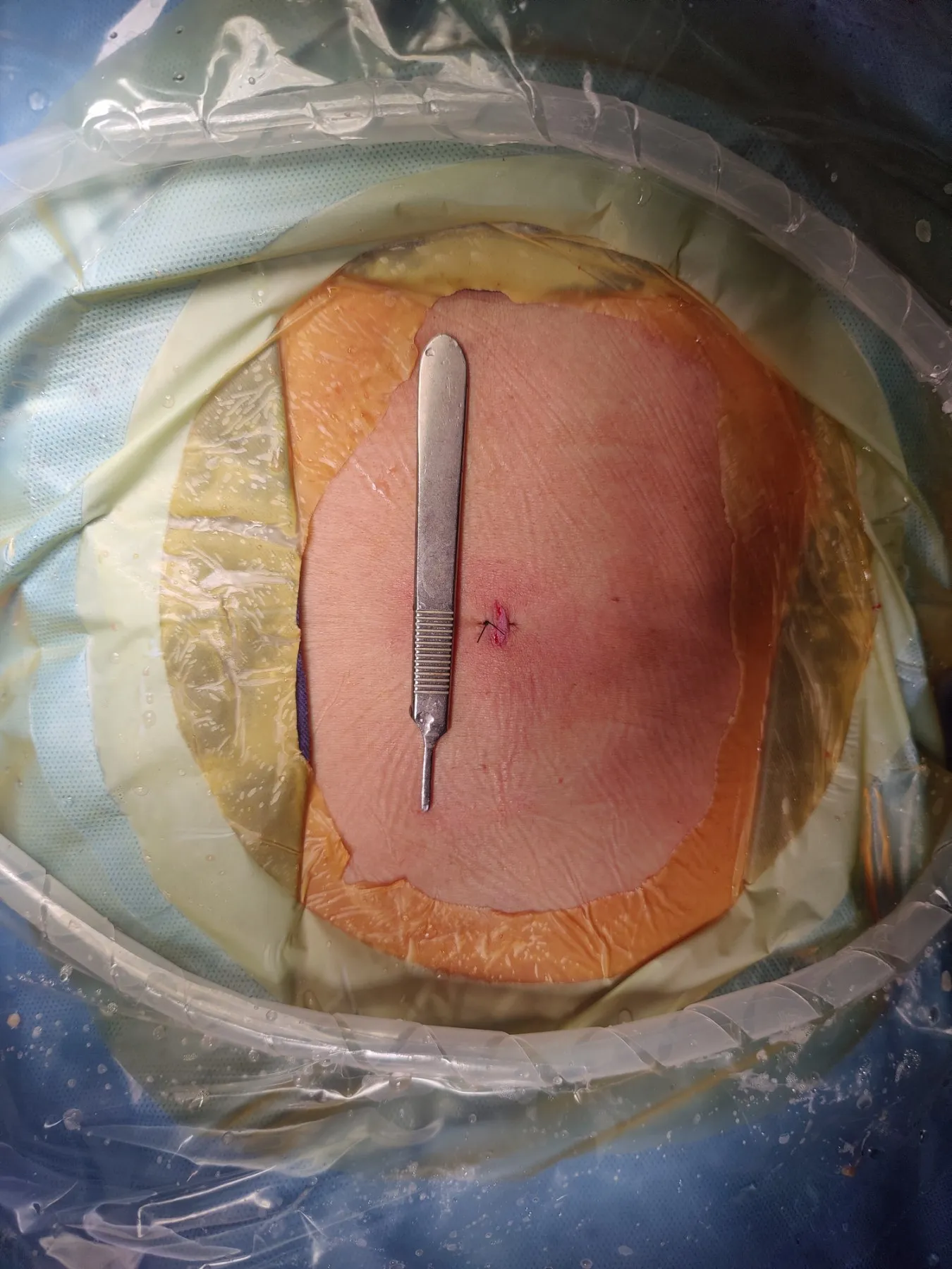 Incision of about 8–10 mm after endoscopic spine surgery