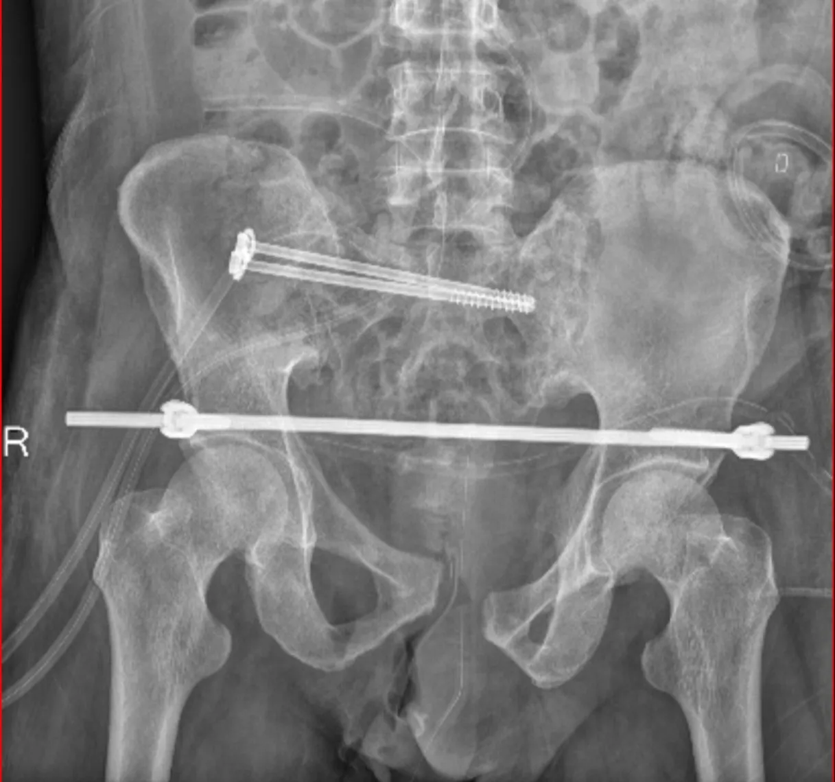 Hip fixation surgery