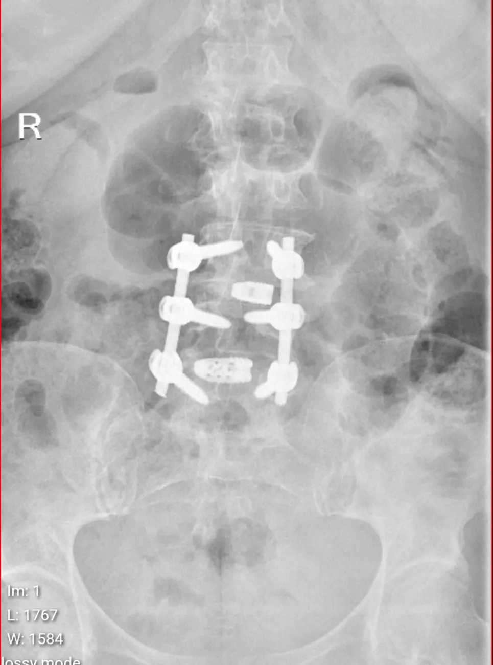 Post-operative X-ray of lumbar spinal fusion